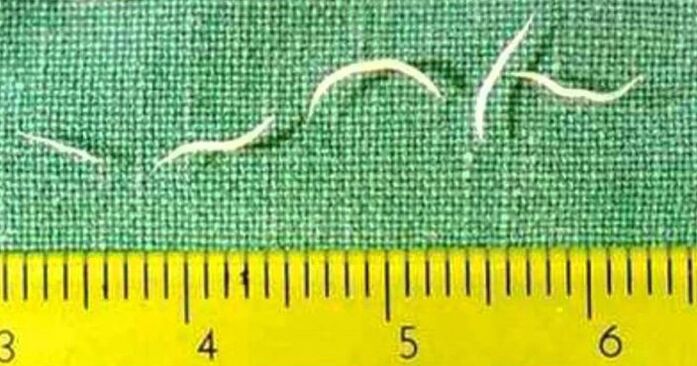Pinworms adalah jenis cacing yang paling biasa ditemui pada kanak-kanak kecil. 