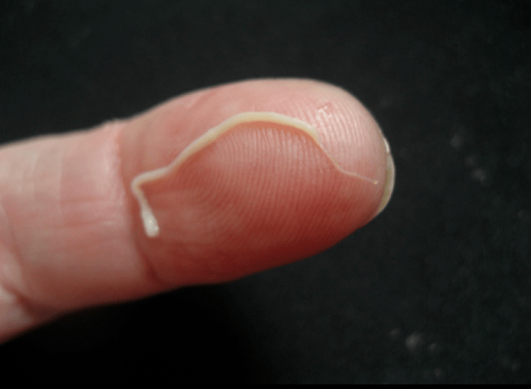 Parasit cacing bulat dari tubuh manusia